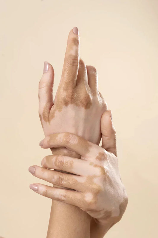 Vitiligo et sans gluten : existe-t-il un lien ?